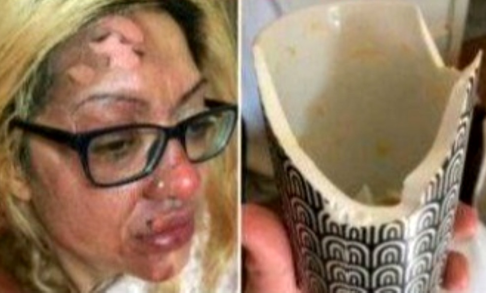 Mikróban próbált tojást buggyantani egy nő, szénné égett az arca